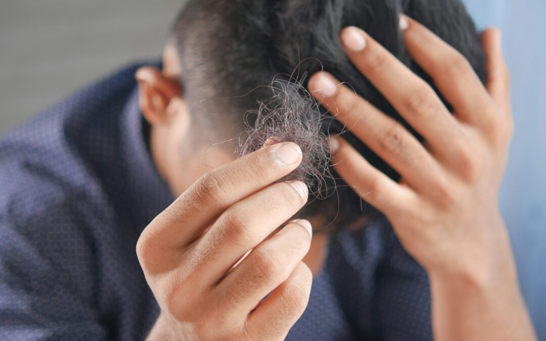 Sylfirm: A Revolution In Men&rsquo;s Hair Restoration