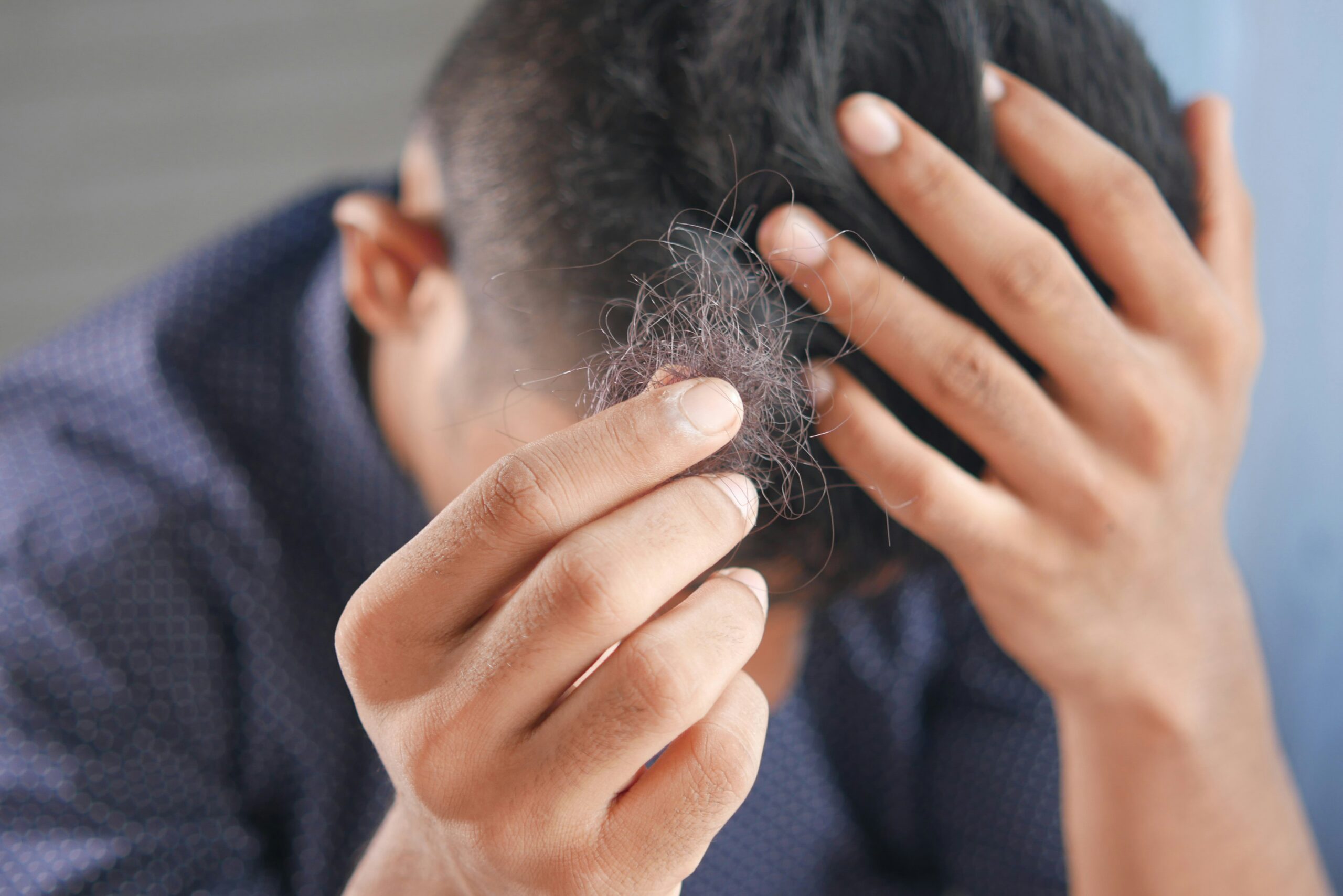 towfiqu-barbhuiya-FGqEuM0wuKk-unsplash A man with visible hair thinning holding a small lock of his hair